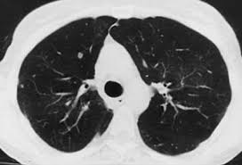 Small_airways _disease